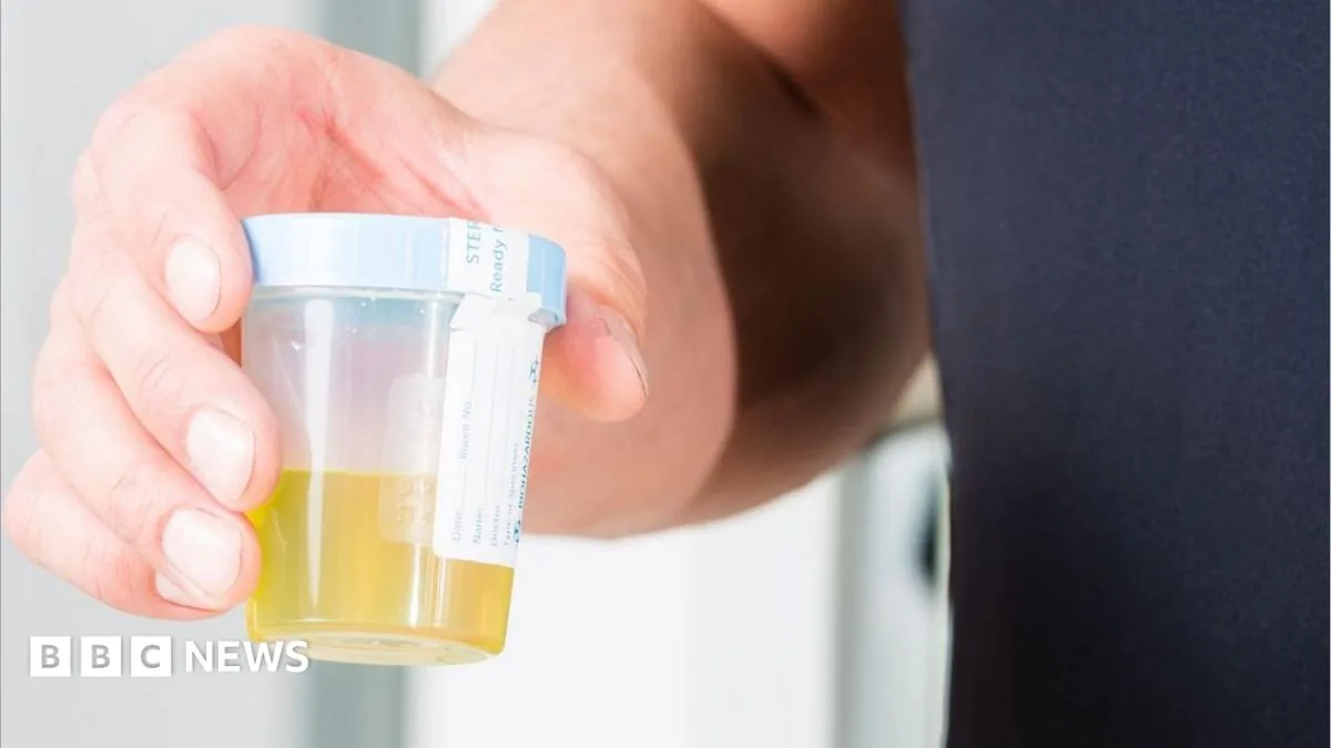 A laboratory urine sample being analysed for signs of bladder cancer